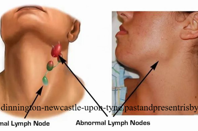 Kenali Penyebab Kanker Getah Bening dan Siapa Saja