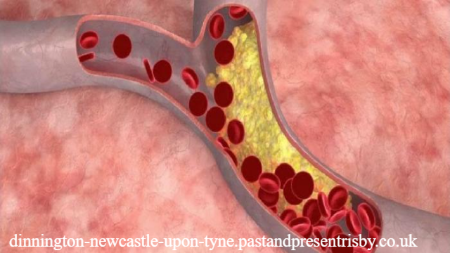 Penyebab Sirkulasi Darah Tidak Lancar dan Dampaknya